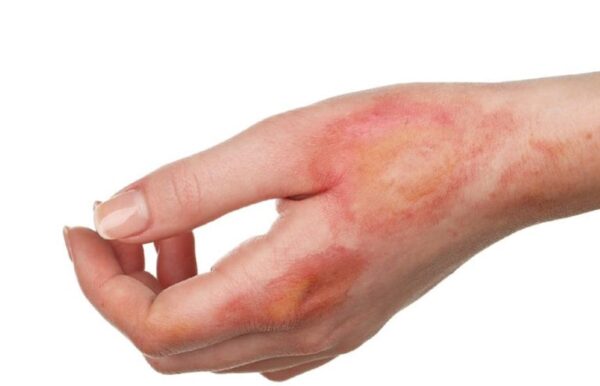 First Aid for Burns in Nigeria: Best Remedies for Quick Relief
